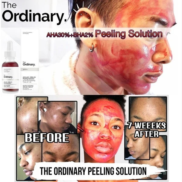 💖Peeling The Ordinary®🩸50% OFF🔥