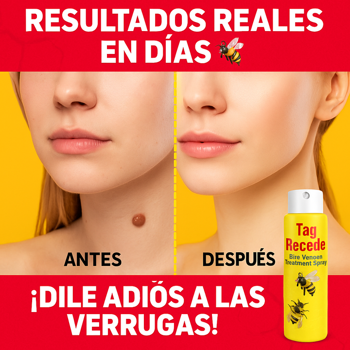 TRATAMIENTO PARA VERRUGAS Y LUNARES🐝👨‍⚕🚚 ENVIO GRATIS Y PAGA AL RECIBIR 🚚