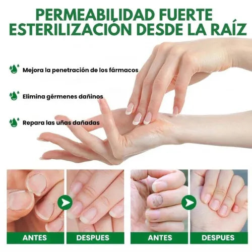 Paga 1, llévate 2🔥Protege y elimina el hongo de tus Uñas