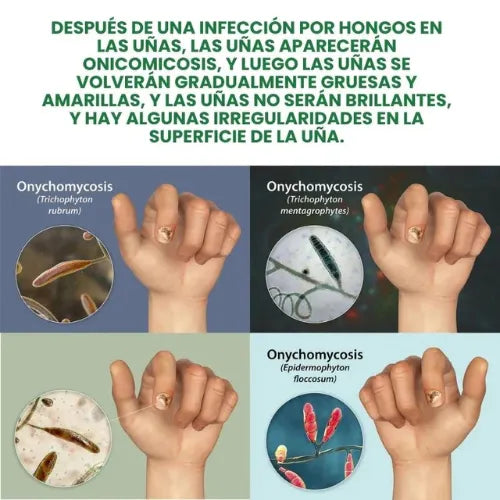 Paga 1, llévate 2🔥Protege y elimina el hongo de tus Uñas