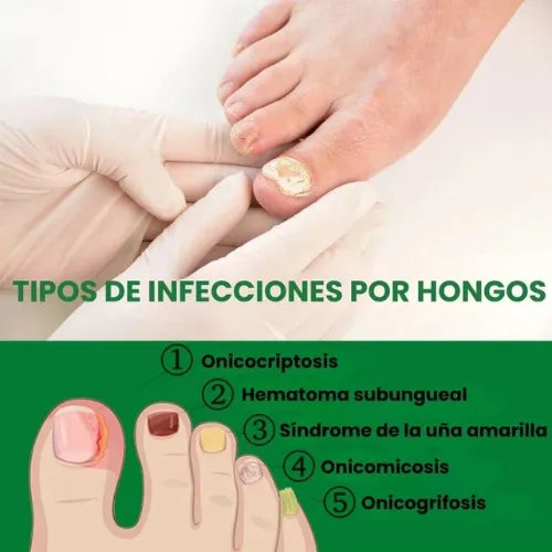 Paga 1, llévate 2🔥Protege y elimina el hongo de tus Uñas